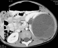 Cystic Renal Cell Carcinoma - CTisus CT Scan