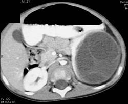 Cystic Renal Cell Carcinoma - CTisus CT Scan