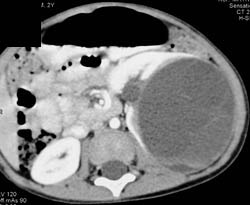 Cystic Renal Cell Carcinoma - CTisus CT Scan