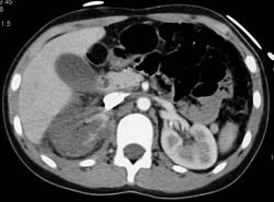 Injury to Right Renal Artery With Delayed Function - CTisus CT Scan