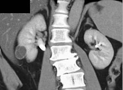 Septated Complex Cyst - CTisus CT Scan