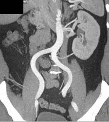 Solitary Left Kidney - CTisus CT Scan