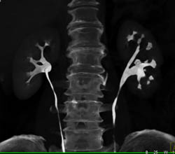 Blunted Calyces and Scarring Left Kidney - CTisus CT Scan