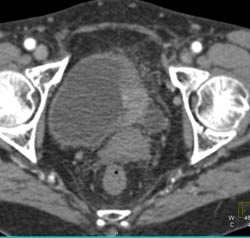 Bladder Cancer - CTisus CT Scan