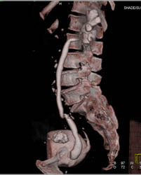 Bladder Cancer - CTisus CT Scan