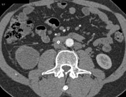 Cystic Renal Cell Carcinoma Right Kidney - CTisus CT Scan