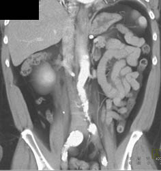 Stone in Mid Right Ureter Obstructs the Kidney - CTisus CT Scan