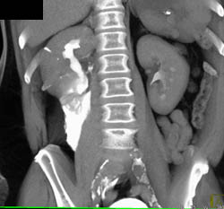 Pyelosinus Extravasation of Contrast Due to Stone Causing Obstruction - CTisus CT Scan