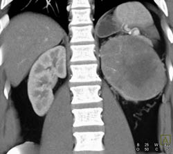 Mildly Vascular Renal Cell Carcinoma - CTisus CT Scan