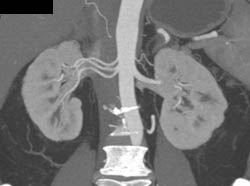 2 Right Renal Arteries With Prehilar Branching in Inferior Vessel in Potential Renal Donor. Tiny 2nd Left Renal Artery to Upper Pole Also Seen - CTisus CT Scan