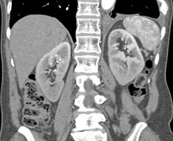 Case Looks Like Acute Pyelonephritis But Note Lower Pole Only Both Kidney With A Straight Line. This Was Radiation Nephritis - CTisus CT Scan