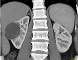 Complex Cyst With Septations - CTisus CT Scan