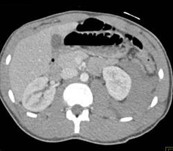 Active Perirenal Bleed - CTisus CT Scan