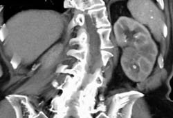 Left Renal Calculi and Subtle Transitional Cell Cancer (TCC) Left Renal Hilum - CTisus CT Scan