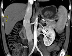 Retroaortic Renal Vein - CTisus CT Scan