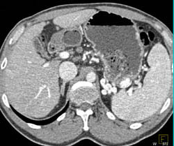 Retroaortic Renal Vein - CTisus CT Scan