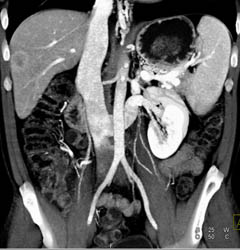 Retroaortic Renal Vein - CTisus CT Scan