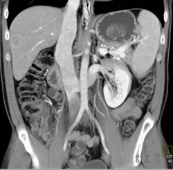 Retroaortic Renal Vein - CTisus CT Scan