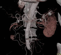 Right Renal Artery Aneurysm- and Splenic Artery Aneurysm Too! - CTisus CT Scan