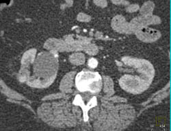 Subtle Recurrent Renal Cell Carcinoma at Ablation Site on Right - CTisus CT Scan