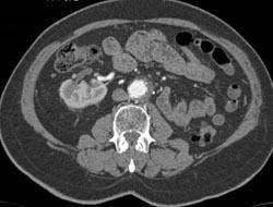 Pelvic Kidney - CTisus CT Scan