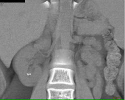 Right Renal Calculi Seen on VRT Enhanced Images Also - CTisus CT Scan