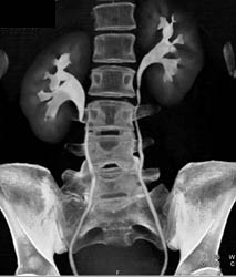 Ct Urogram in Early Retroperitoneal Fibrosis - CTisus CT Scan