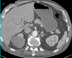 Post Radiofrequency Ablation (RFA) - Right Kidney - CTisus CT Scan