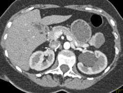 Ureteropelvic Junction (UPJ) With Incidental Intraductal Papillary Mucinous Neoplasm (IPMN) Tail of Pancreas - CTisus CT Scan