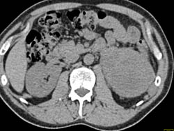 Sequence of Images in An Unusual Transitional Cell Carcinoma - CTisus CT Scan