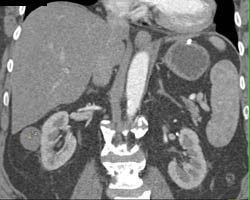 High Density Renal Cyst - CTisus CT Scan