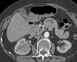 Transitional Cell Carcinoma in Sequence of Images - CTisus CT Scan