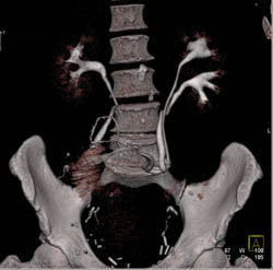 Duplicated Left Collecting System and Ileal Loop - CTisus CT Scan