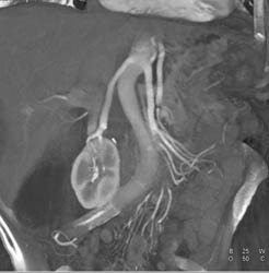 Low Lying Right Kidney With Long Renal Artery - CTisus CT Scan