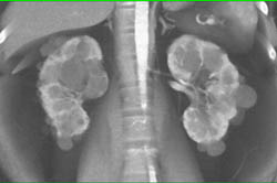 Multiple Renal Cysts and Tumors - CTisus CT Scan