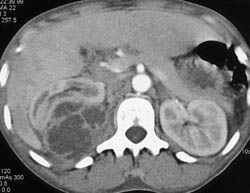 Perirenal Abscess - CTisus CT Scan