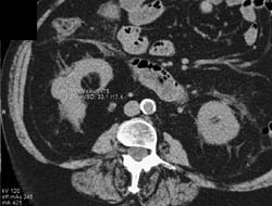 High Density Renal Cyst - CTisus CT Scan