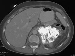 Osteogenic Sarcoma Involves Left Kidney - CTisus CT Scan