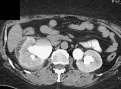 Perirenal Fluid Due to Right Hydronephrosis - CTisus CT Scan