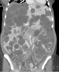 Polycystic Liver and Kidney Disease - CTisus CT Scan