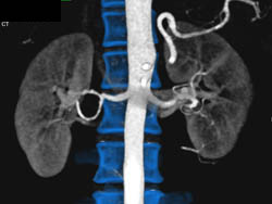 Fibromuscular Dysplasia (FMD) Right Renal Artery - CTisus CT Scan