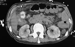 Contrast-induced nephropathy (CIN) - See Kidneys on This Non-contrast Study - CTisus CT Scan