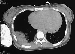 Contrast Extravasation Into Arm - CTisus CT Scan