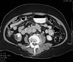 Carcinoma Arises in Renal Cyst - CTisus CT Scan