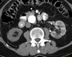 Nonfunction Right Kidney - CTisus CT Scan