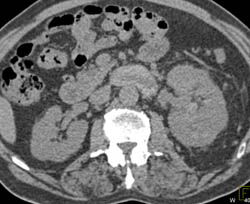 Sequence of Images Shows Renal Cell Carcinoma Invading the Renal Vein - CTisus CT Scan