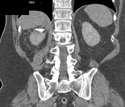 Partial Right Nephrectomy With Mild Contrast Extravasation of Excretory Phase - CTisus CT Scan