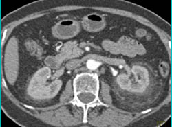 Stranding Around Left Kidney- Possible Erdheim-chester Disease - CTisus CT Scan