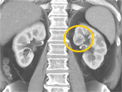 Subtle 2cm Left Renal Cell Carcinoma (RCC) With Multiple Phases and Images to Show Pitfalls of Lesion Detection - CTisus CT Scan