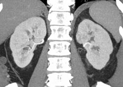 Subtle 2cm Left Renal Cell Carcinoma (RCC) With Multiple Phases and Images to Show Pitfalls of Lesion Detection - CTisus CT Scan